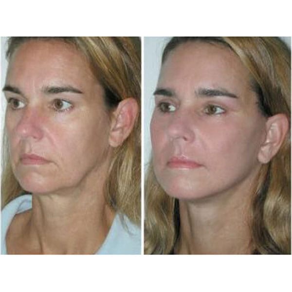 pdo threads for jawline contouring before and after photos