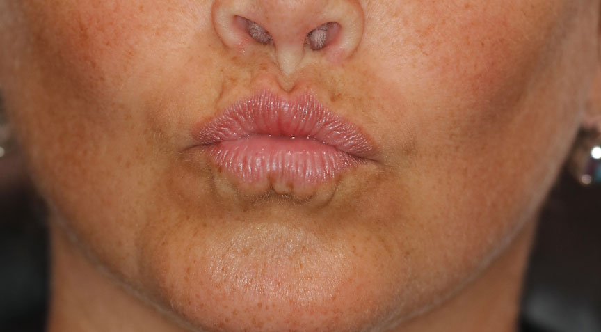 before and after botox lip flip and fillers