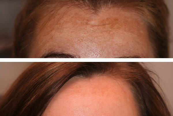 VI Peel for hyperpigmentation before and after photos