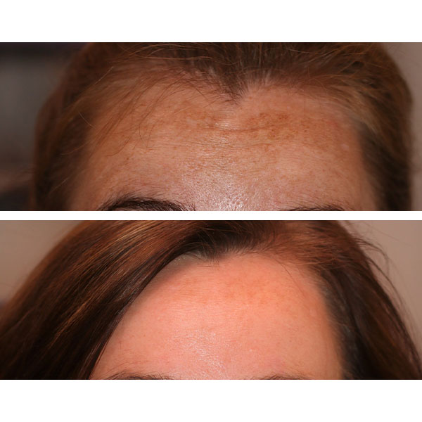 VI Peel for hyperpigmentation before and after photos