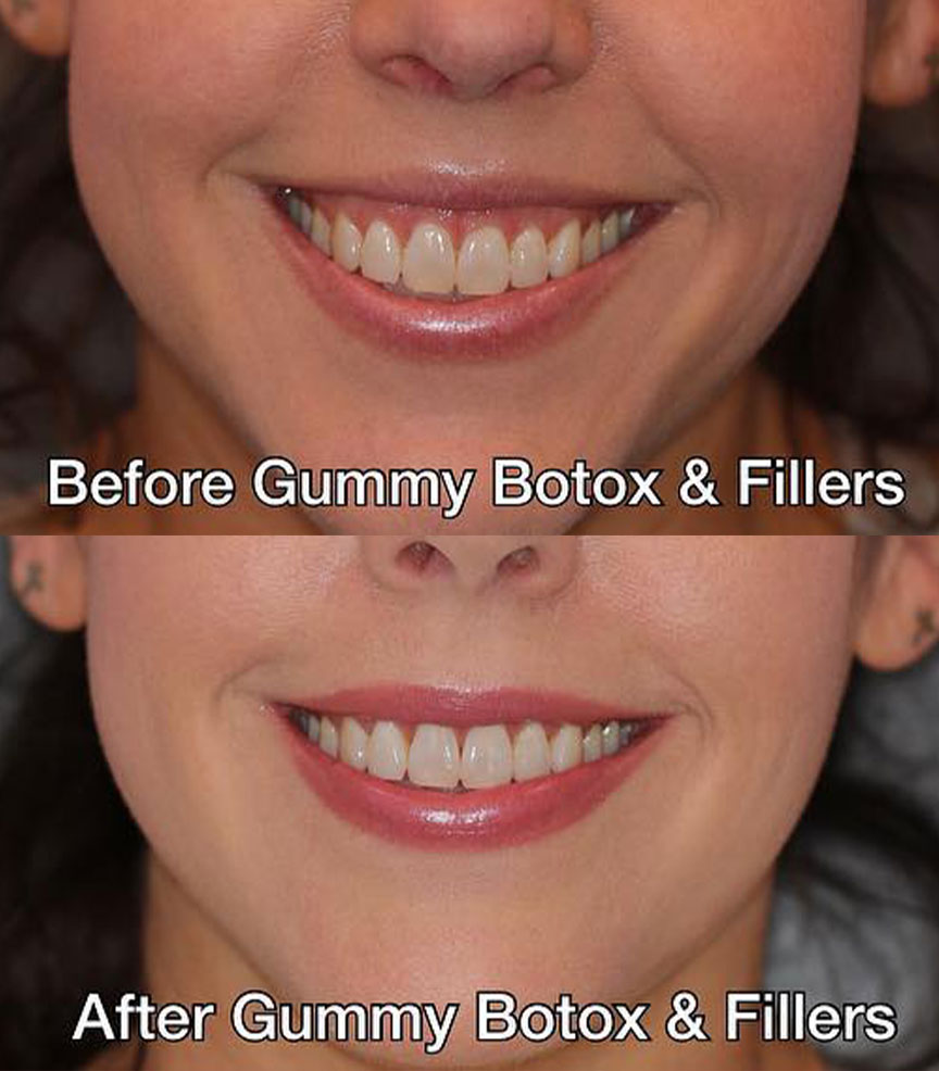 botox for gummy smile before and after