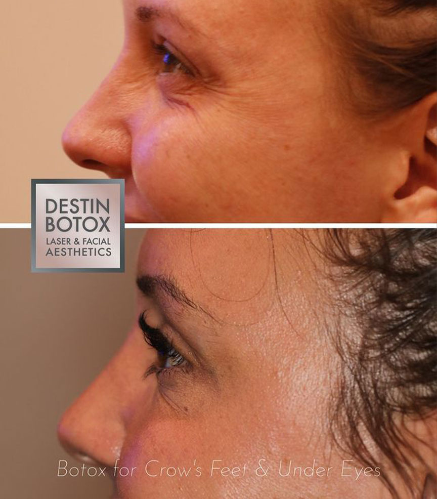 botox for crow's feet and under eye lines