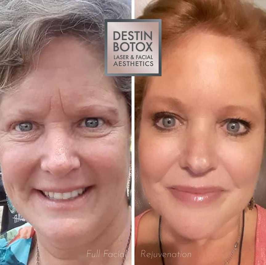 before and after dermal fillers liquid facelift