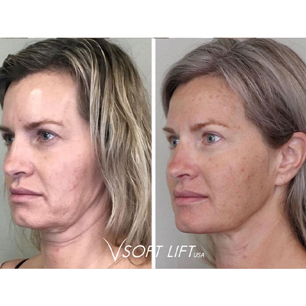 pdo thread lifting facelift before and after