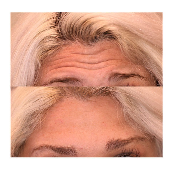 botox for forehead lines before and after