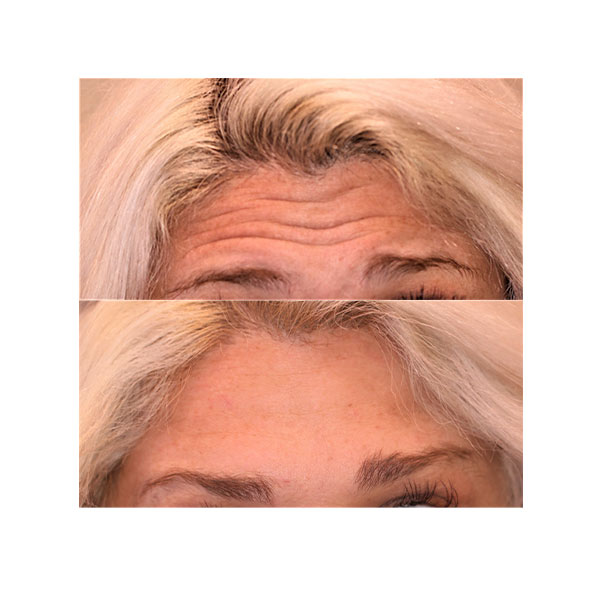 destin botox for frown lines before and after photos