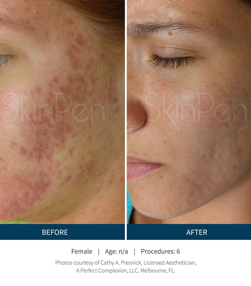 before and after microneedling santa rosa beach