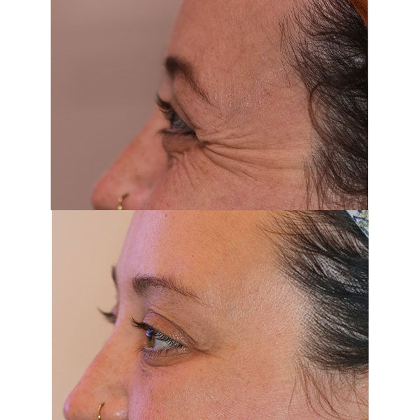 destin botox before and after for crows feet