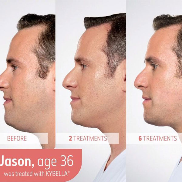 before and after kybella double chin reduction