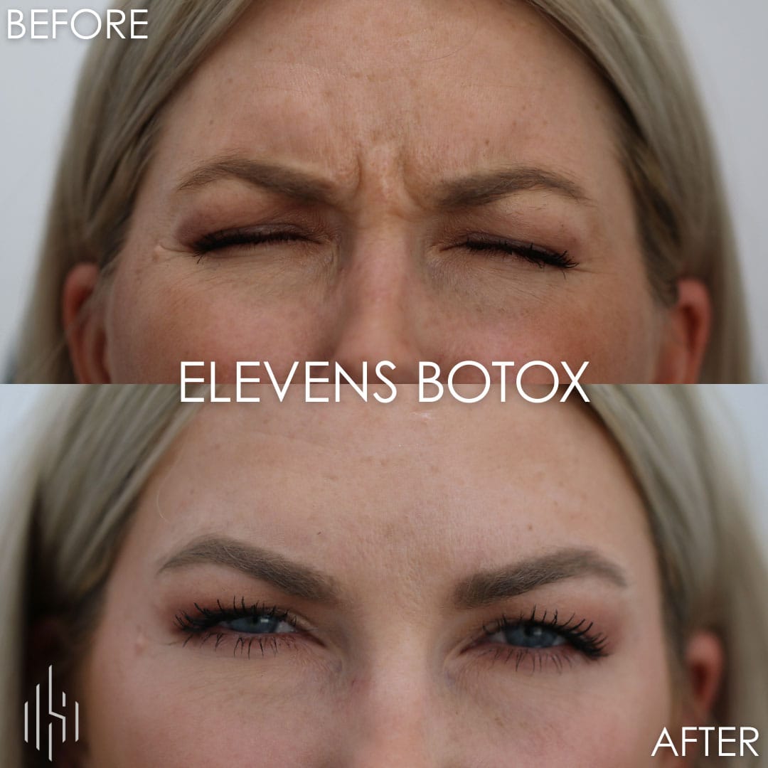 Botox