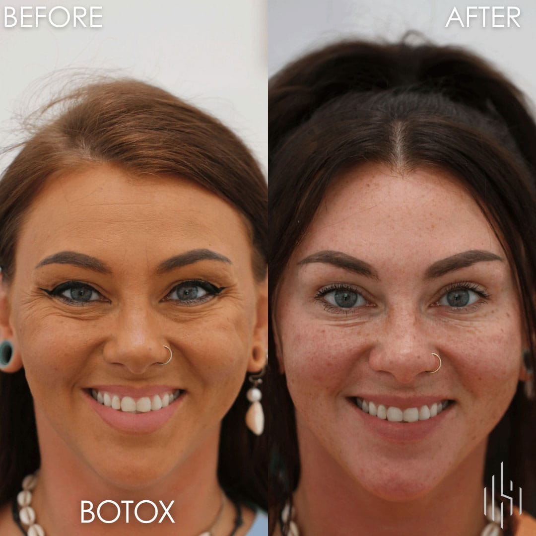 Botox