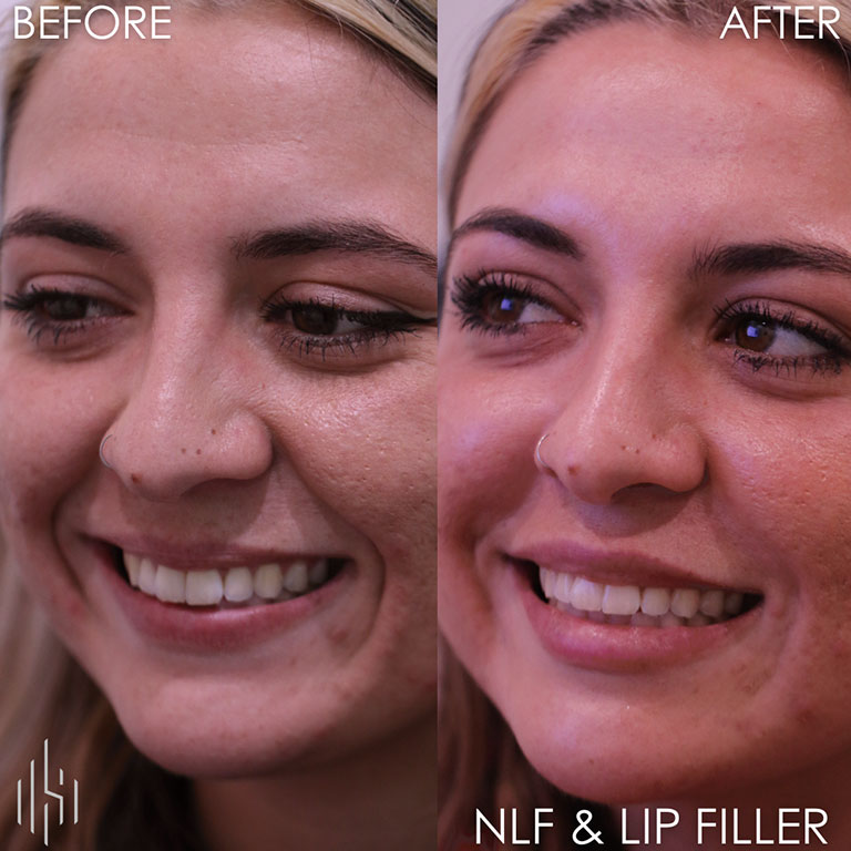 Dermal Fillers