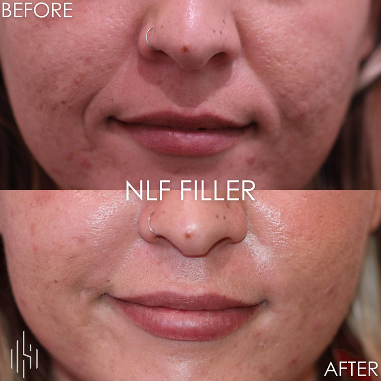 Dermal Fillers