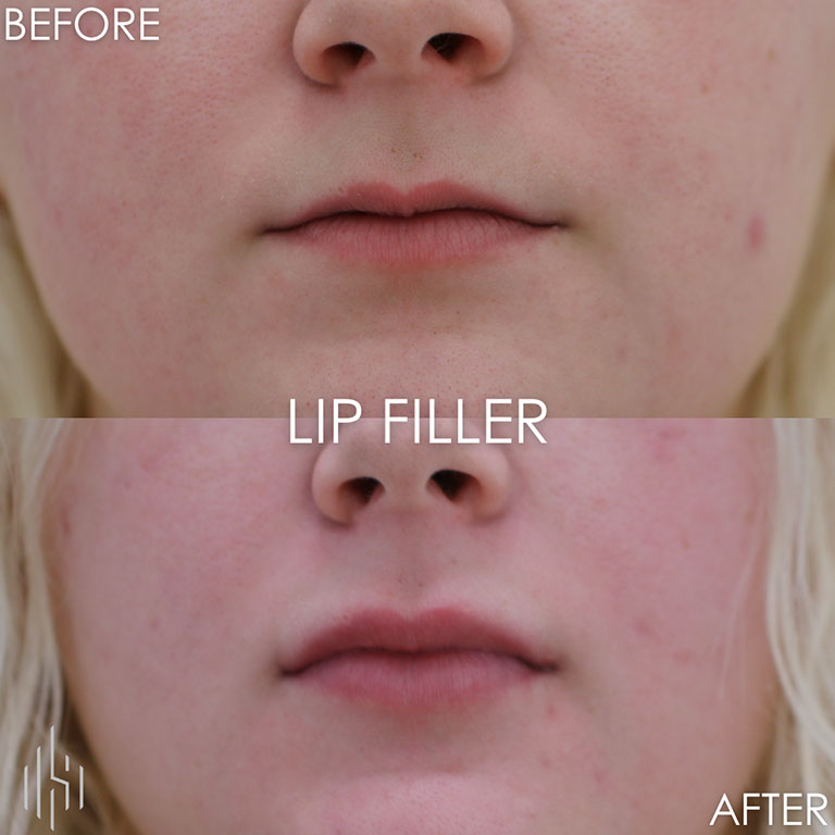 Dermal Fillers