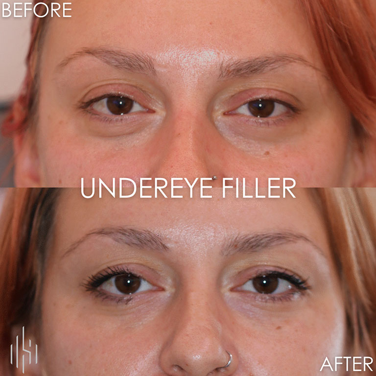 Dermal Fillers