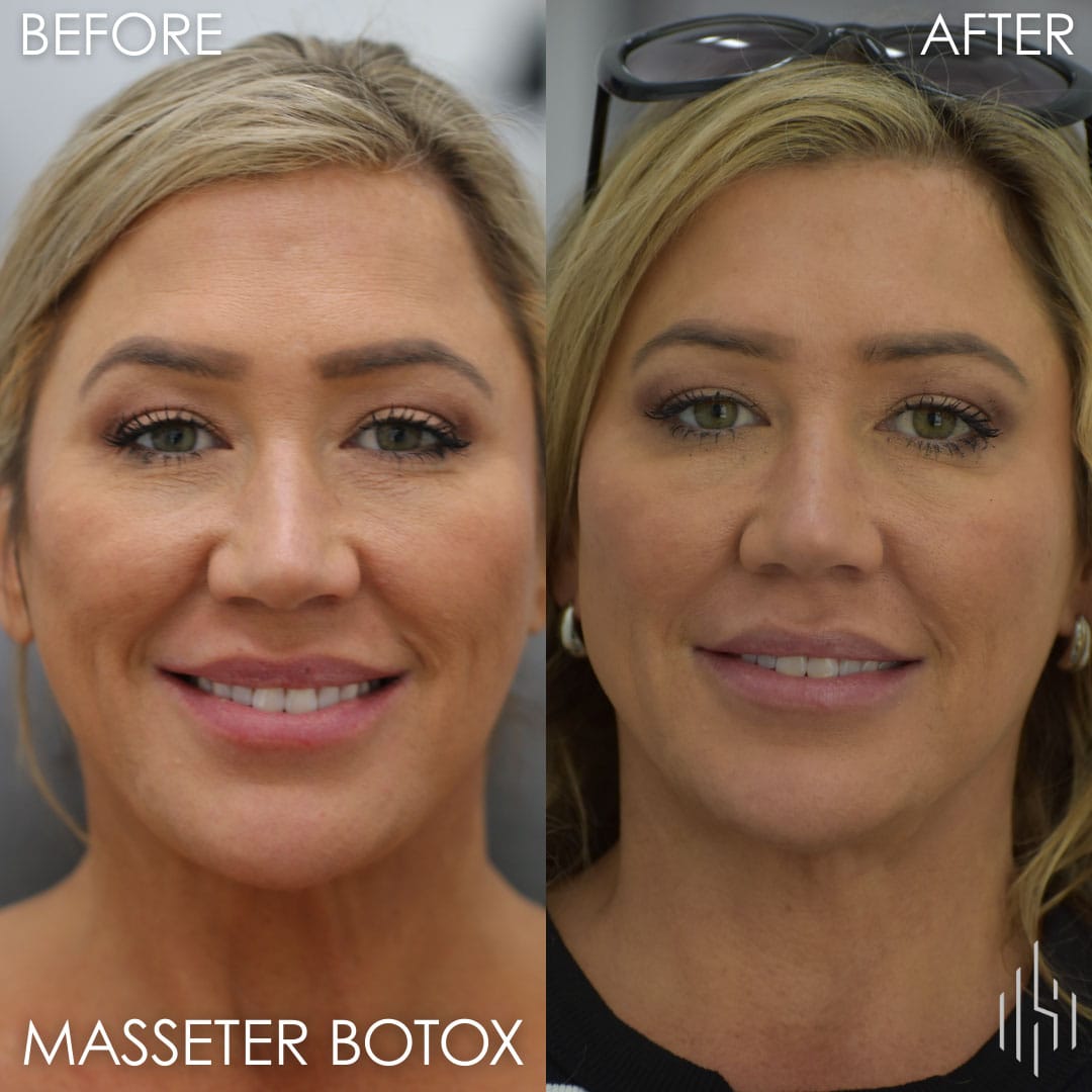 Botox