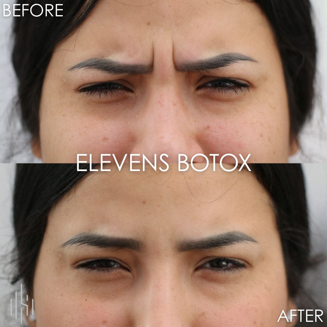 Botox