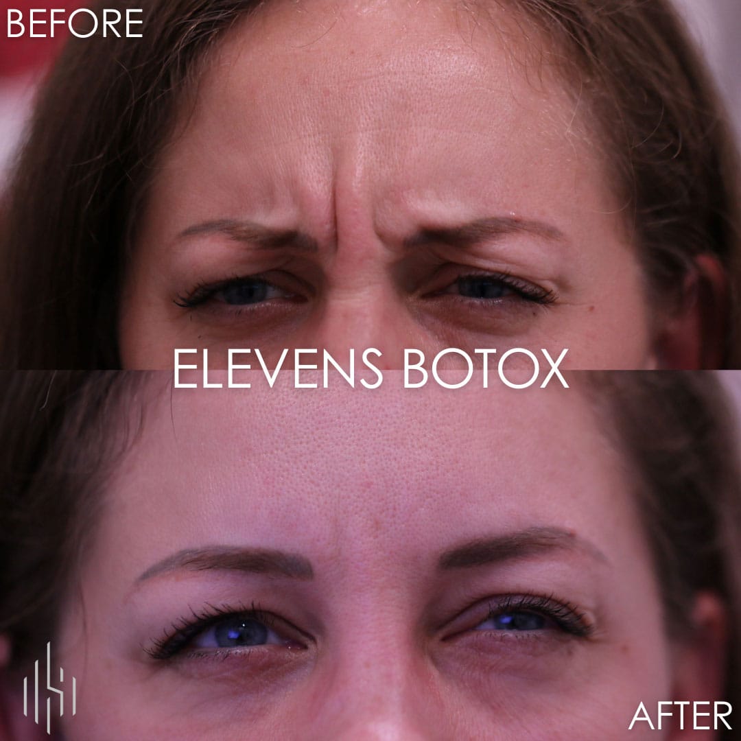 Botox