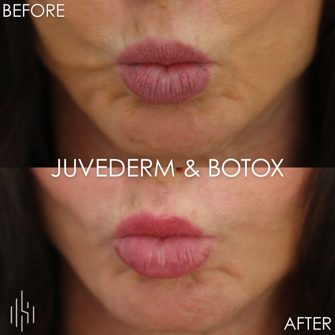 Botox & Filler