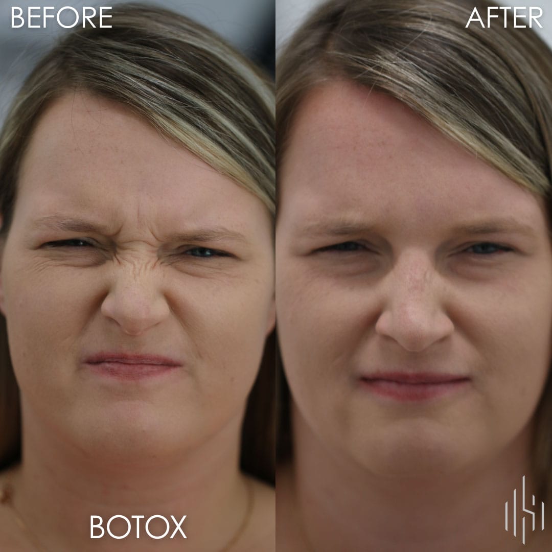 Botox