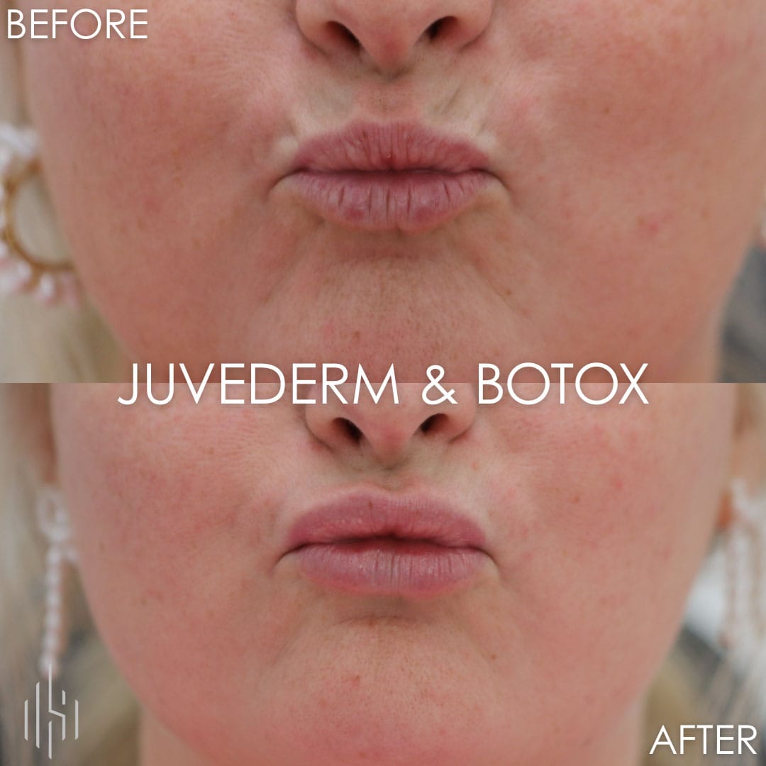 Botox & Filler