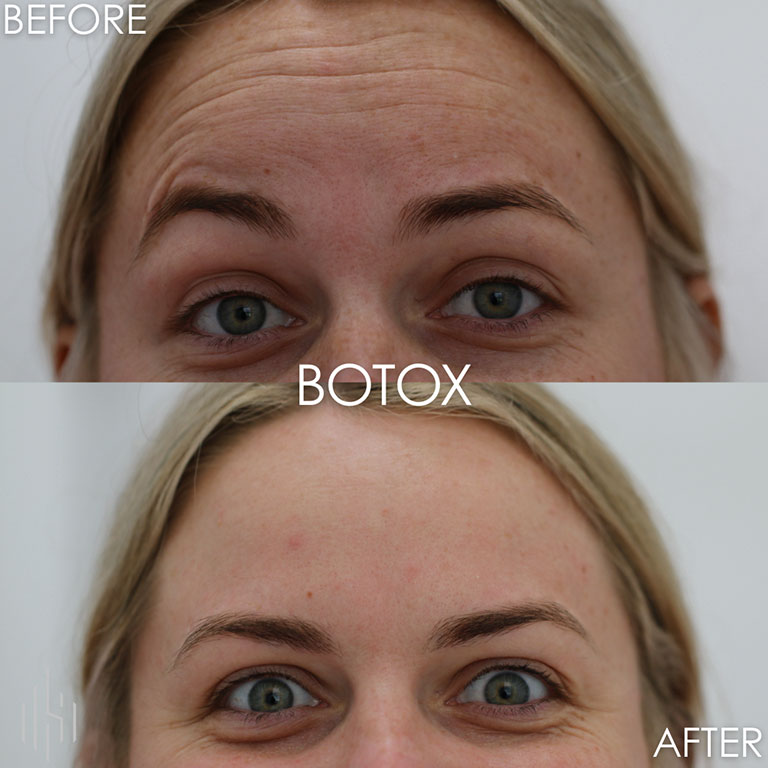 Botox