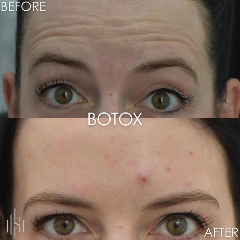 Botox