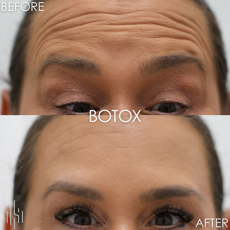 Botox