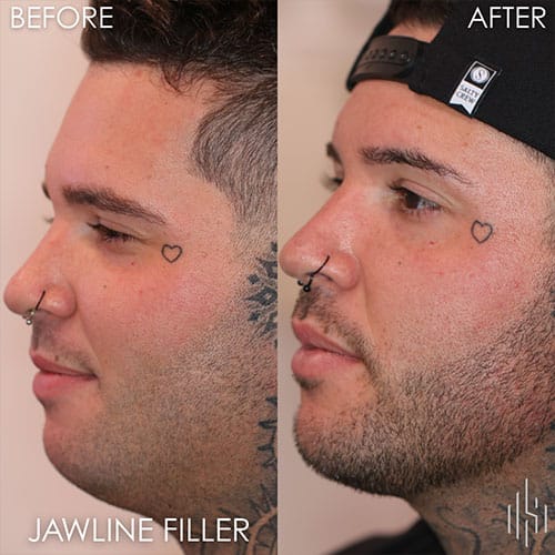 Dermal Fillers