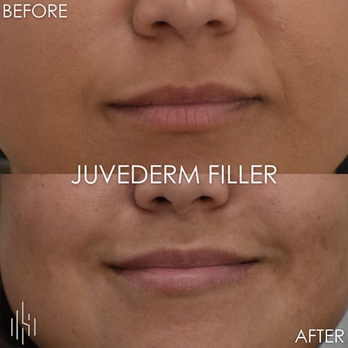 Dermal Fillers