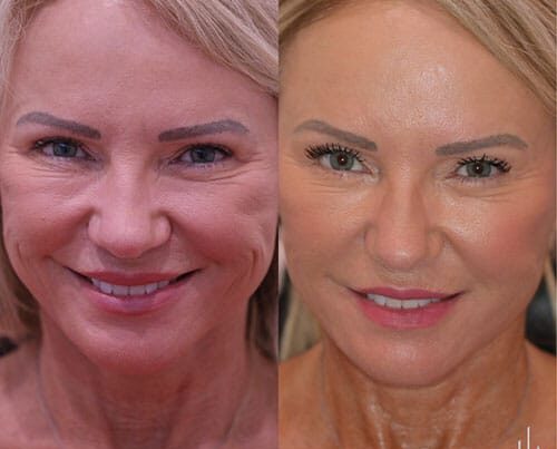 Female before and after liquid facelift front facing profile of female smiling