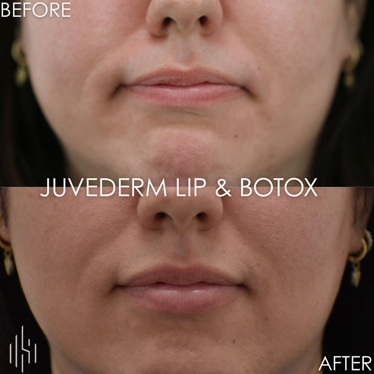 Dermal Fillers & Botox