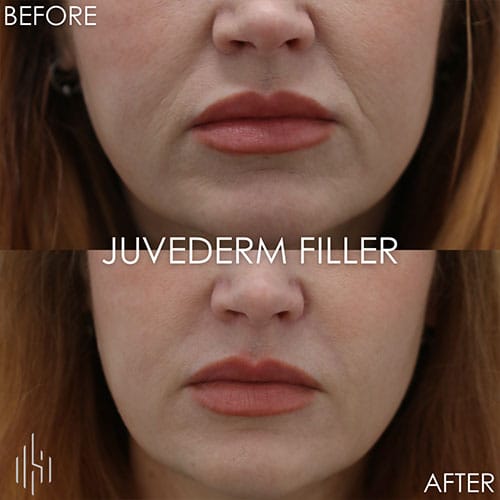 Dermal Fillers