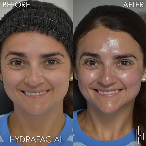 HydraFacial
