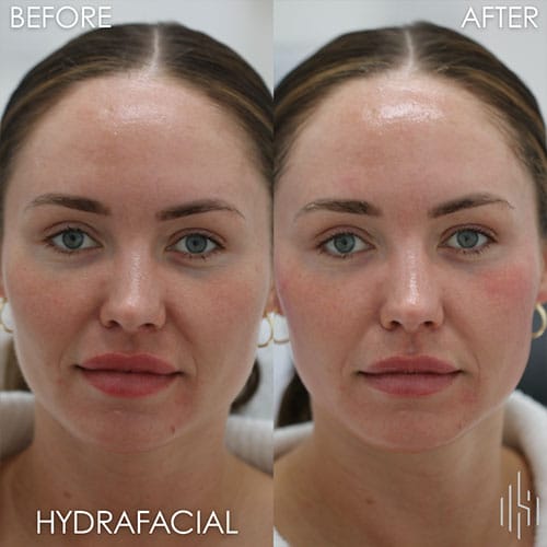 HydraFacial