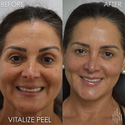 Vitalize Peel