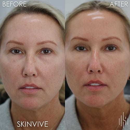 Microneedling (SkinPen)