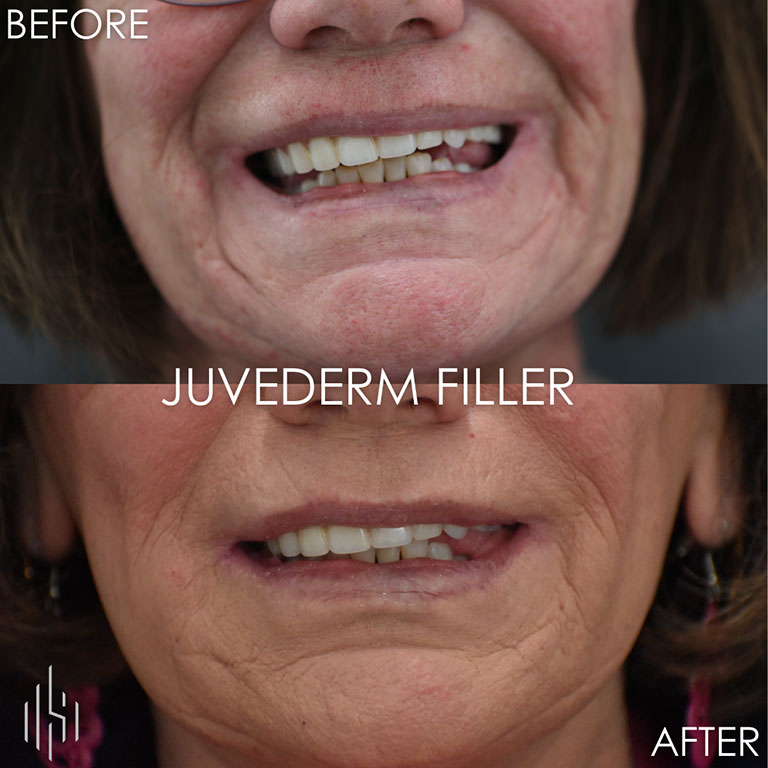 Dermal Filler