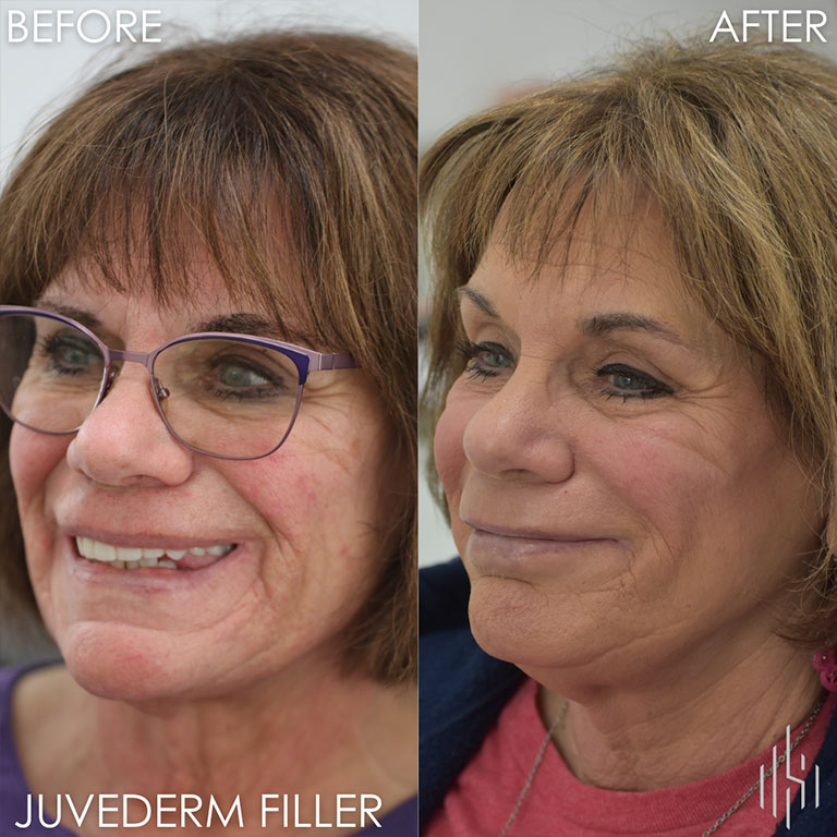 Dermal Filler